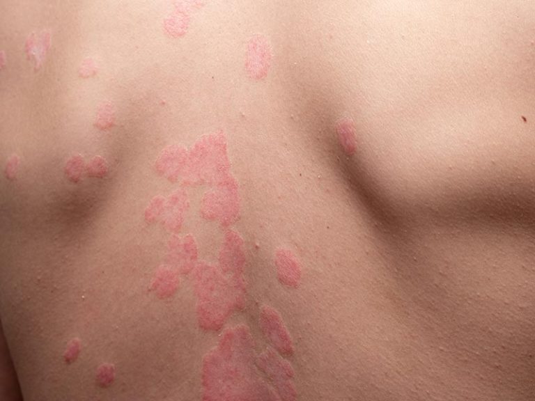 Psoriasis
