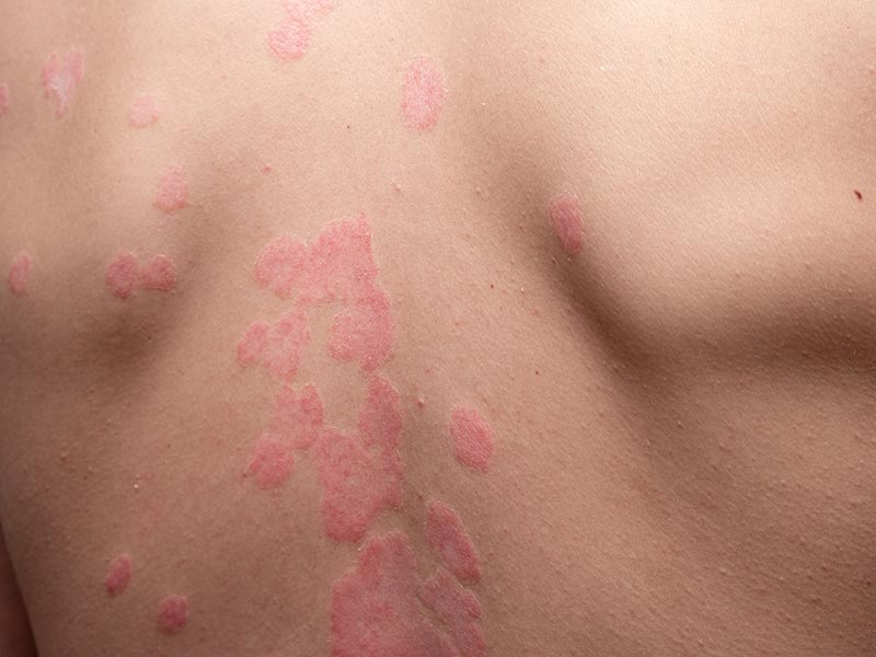 Psoriasis