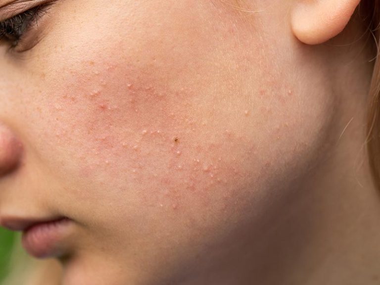 Rosacea