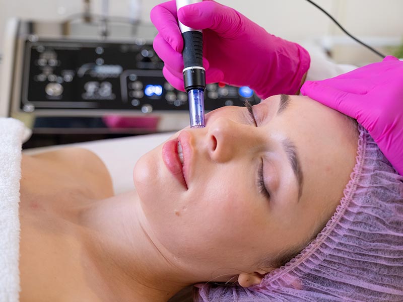 Radio Frequency Microneedling
