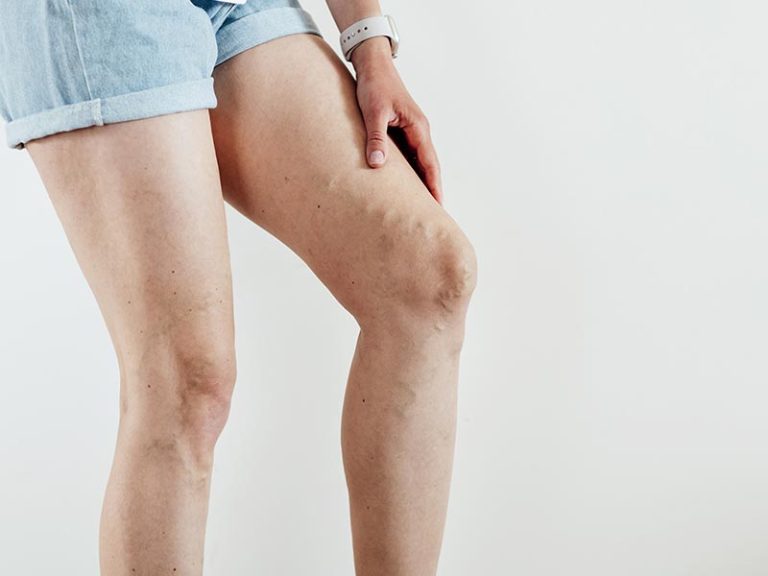 Sclerotherapy